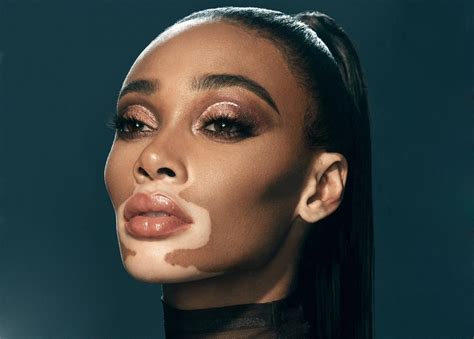 vitiligo nude|Model Winnie Harlow Proudly Shows Her Vitiligo in a New Nude。